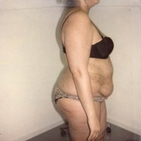 Voor behandeling - zijaanzicht